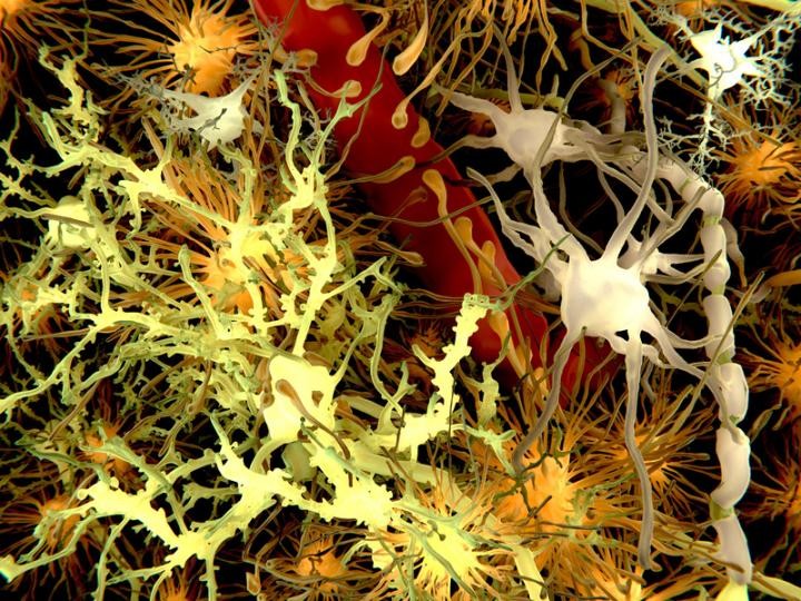 Click to enlarge Amyloid plaques