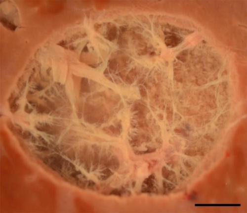 Click to enlarge histotripsy lesion
