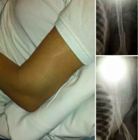 arm_x-rays