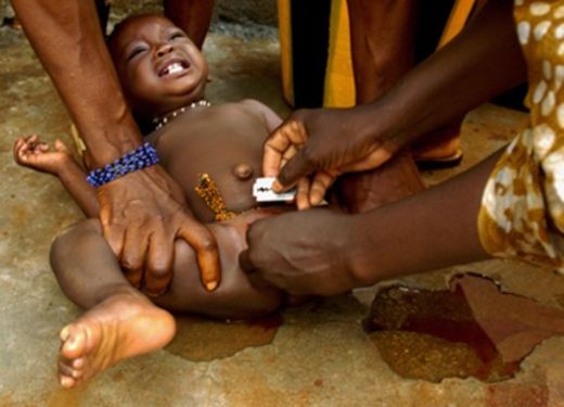 FGM