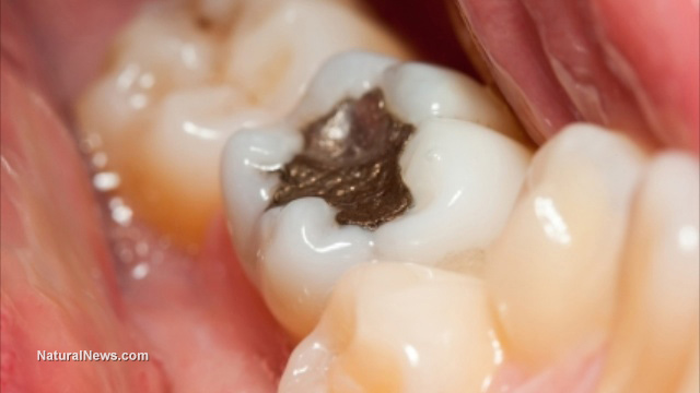 mercury amalgam