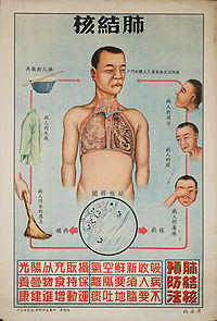 Click to enlarge tuberculosis poster