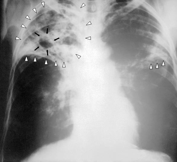 tuberculosis x ray