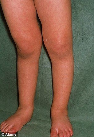 Click to enlarge rickets