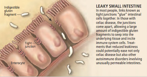 leaky gut