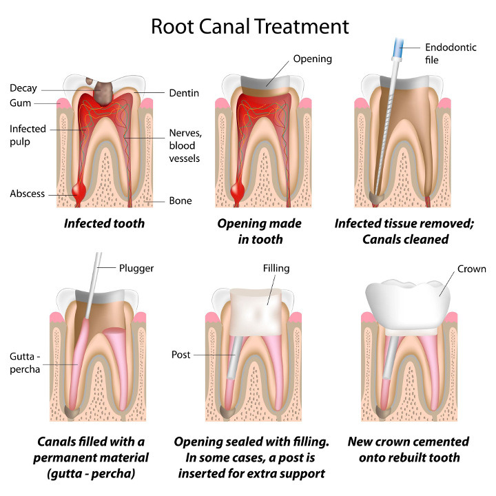 Click to enlarge Root Canal