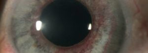 eye