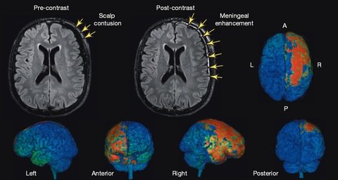 brain, concussion