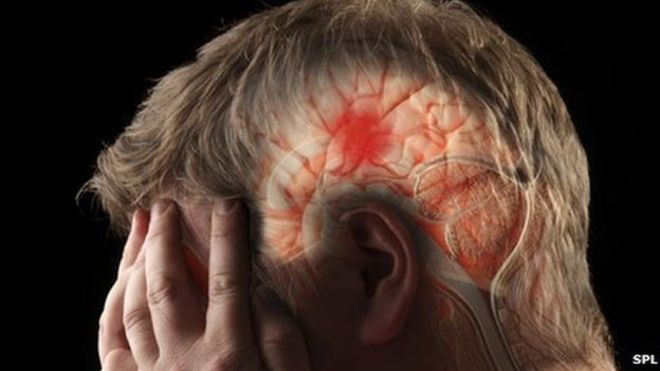 stroke victim