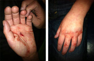 smashed hand