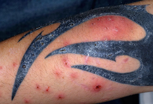 mrsa infection tatoo