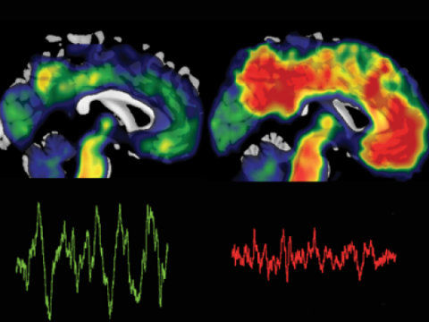 Click to enlarge deposits beta-amyloid
