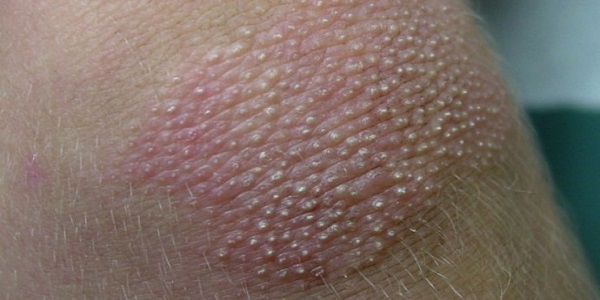 skin disorder