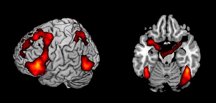 female and male brain psychopathy