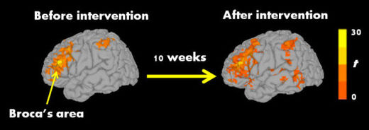 autism intervention