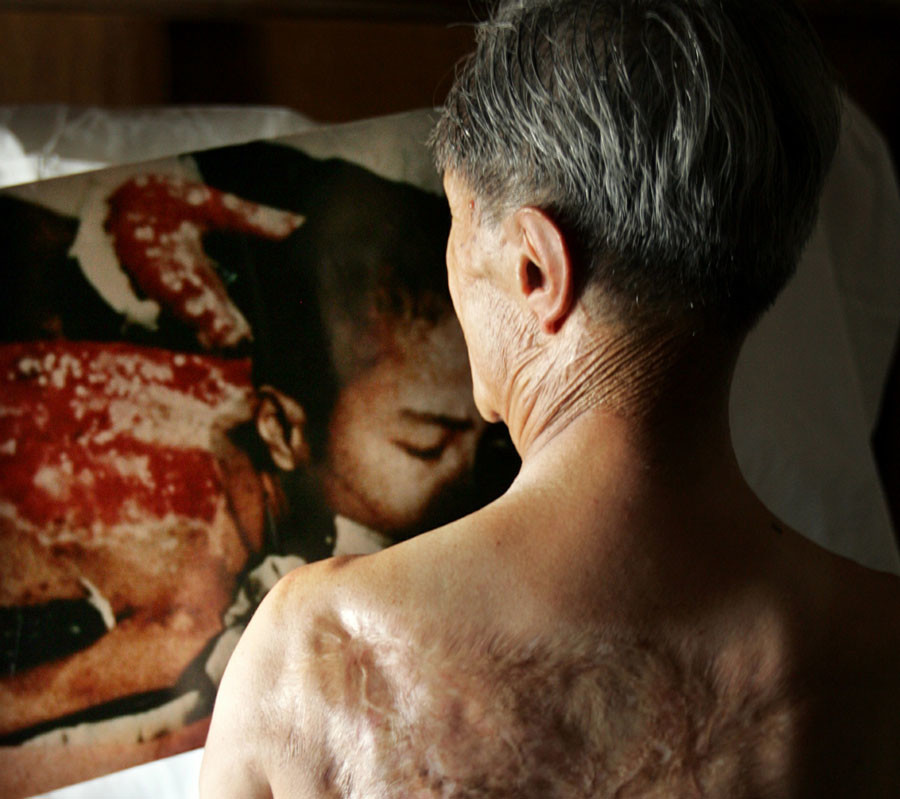 Click to enlarge Victim of Atom bomb