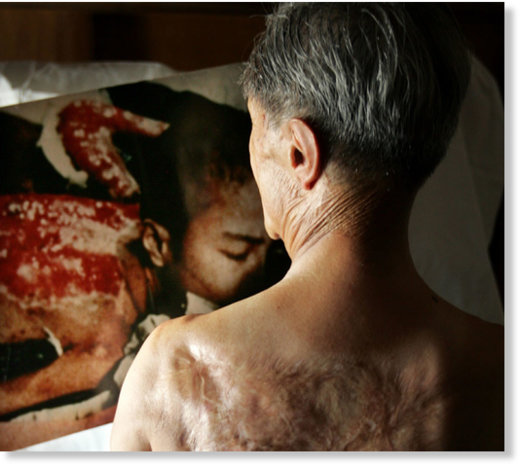 Click to enlarge Victim of Atom bomb