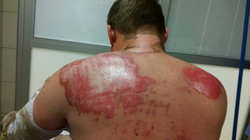 Cody Murray burns