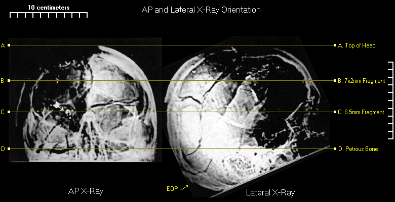 jfk xray