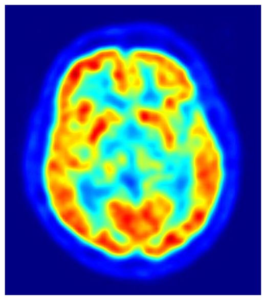 Click to enlarge PET Scan