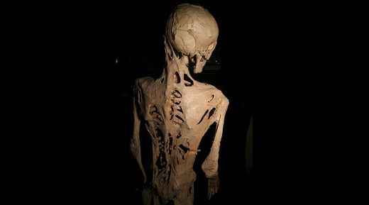 stone man disease