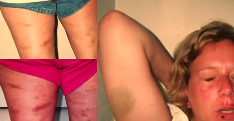 maggie bruises
