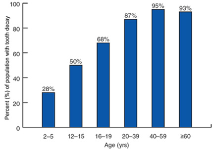 Click to enlarge tooth decay chart