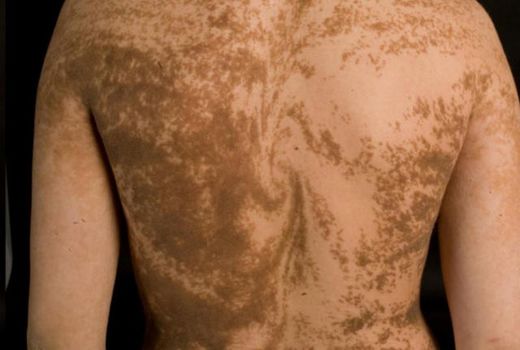 Click to enlarge human stripes