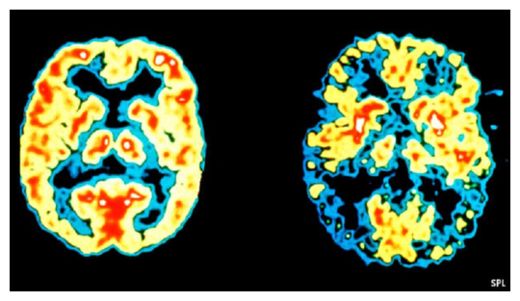 Click to enlarge Fungi in the Brain