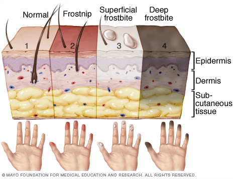 Click to enlarge frostbite