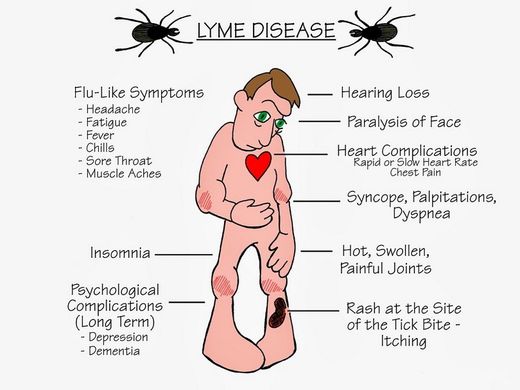 lyme disease