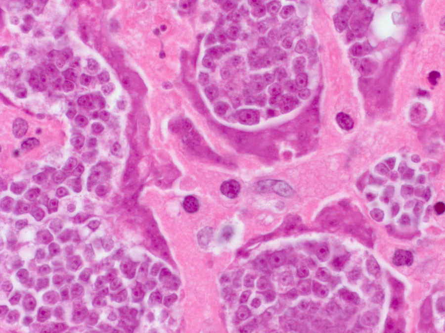 Click to enlarge ccancer cells