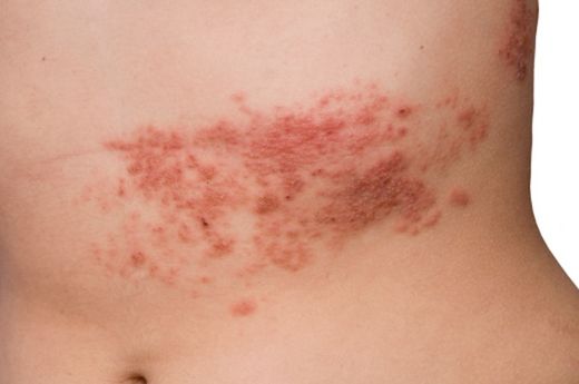 Click to enlarge shingles infection