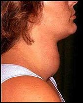 Click to enlarge goiter