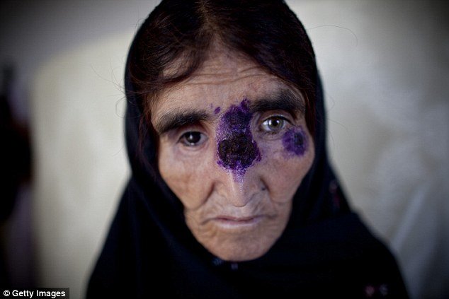 syrian woman flesh eating disease