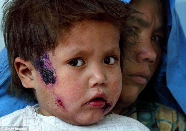 Click to enlarge syrian boy flesh eating disease