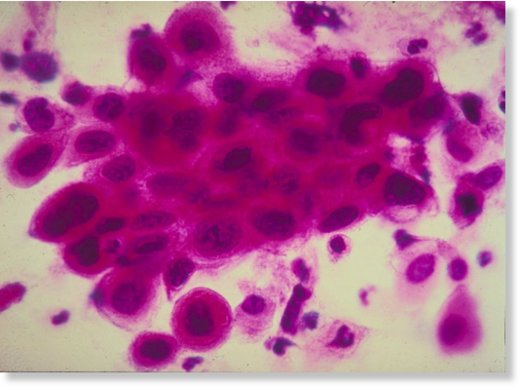 Cancer cells