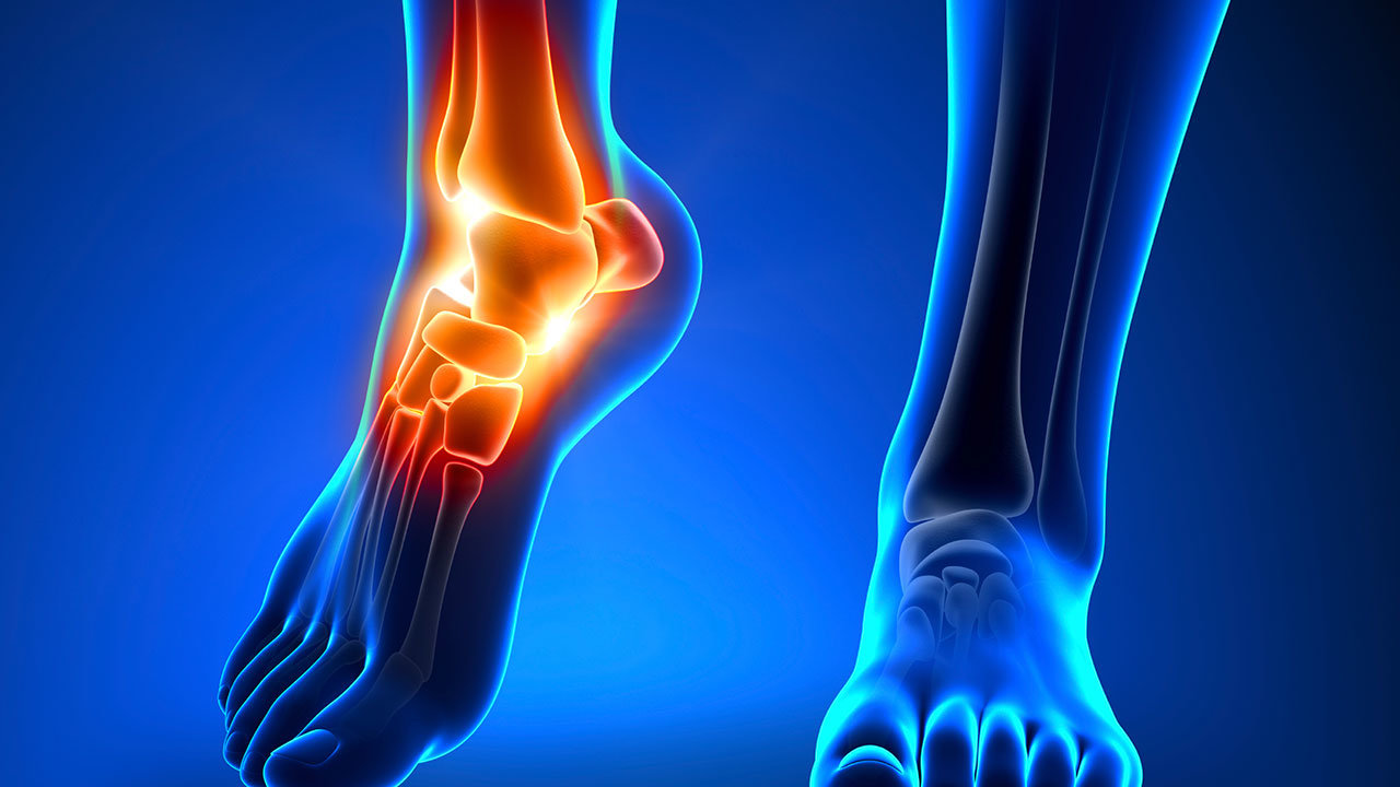 plantar fasciitis, foot pain
