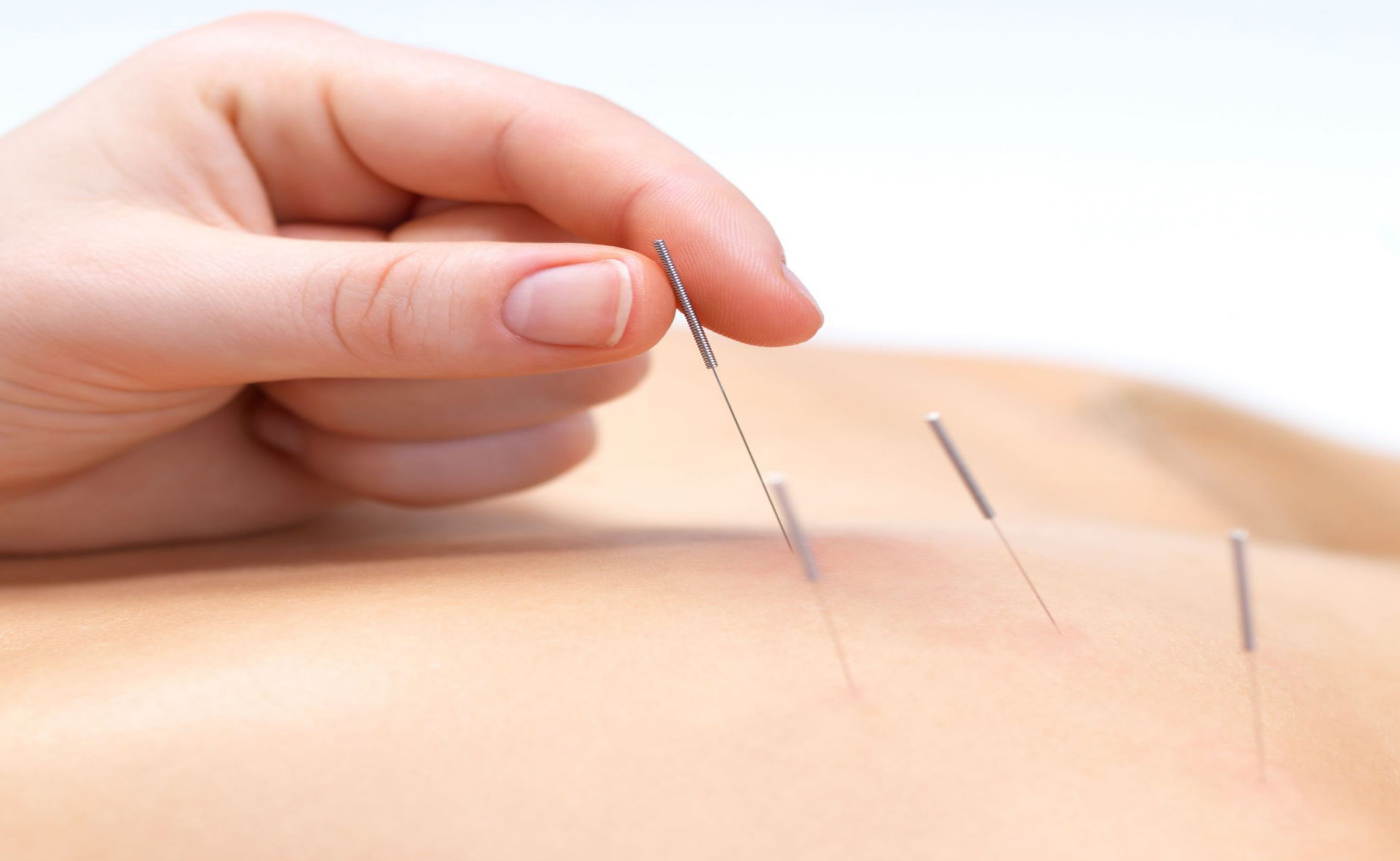 acupuncture