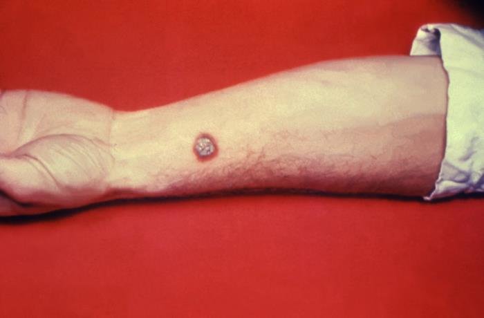 Cutaneous anthrax lesion 