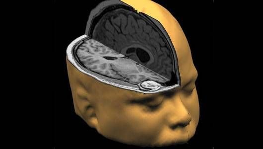 Brain head