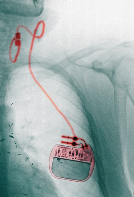 Click to enlarge vagus nerve stimulators