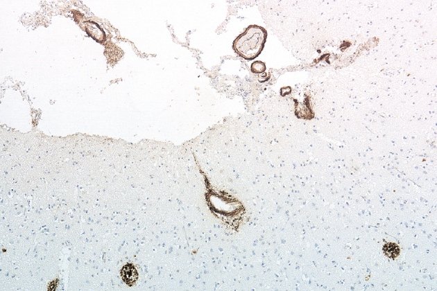 Click to enlarge Deposits of amyloid-β protein (brown) in the frontal cortex of patients who developed CJD after surgery