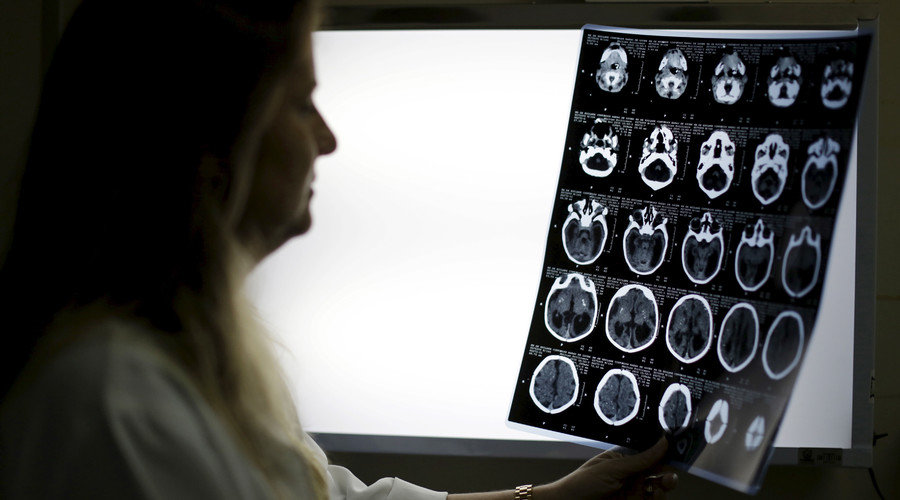 Click to enlarge microcephaly x-rays