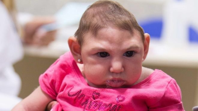 Zika, zika virus, brain damage