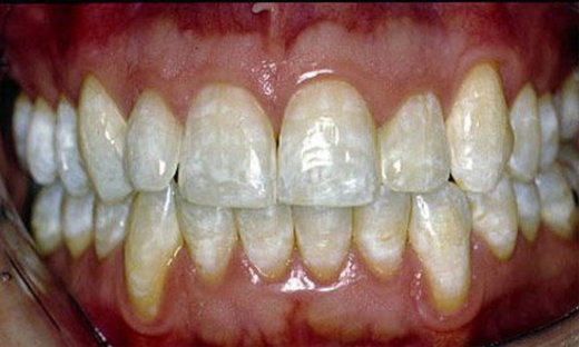 Fluoride