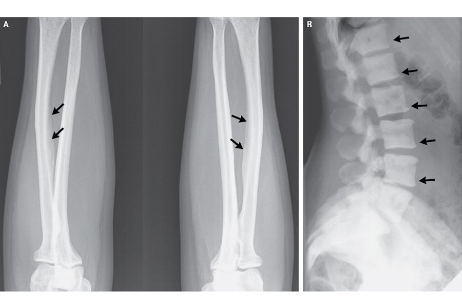 skeletal fluorosis