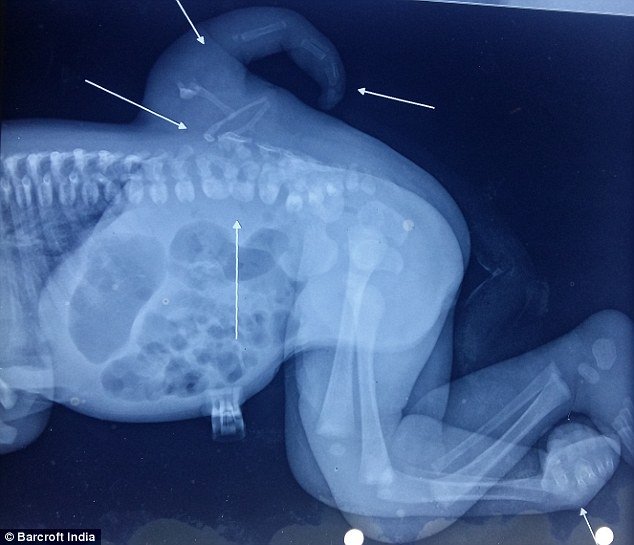 Pictured is an X-ray of Versha's extra leg