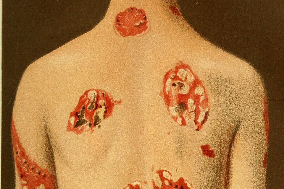 Click to enlarge syphilis