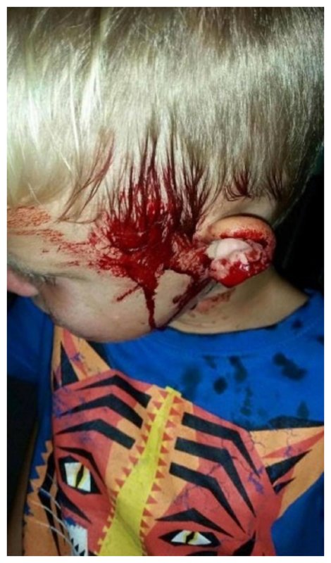 Click to enlarge Snake Bite